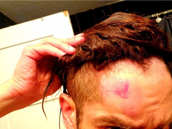 A photograph of purple bruising on Sauter's forehead following the incident