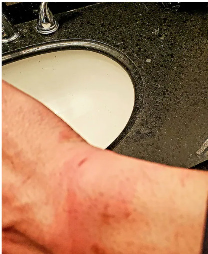 A photograph of bruising on Sauter's wrist following the incident