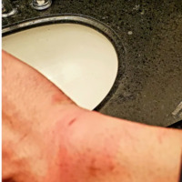 A photograph of bruising on Sauter's wrist following the incident